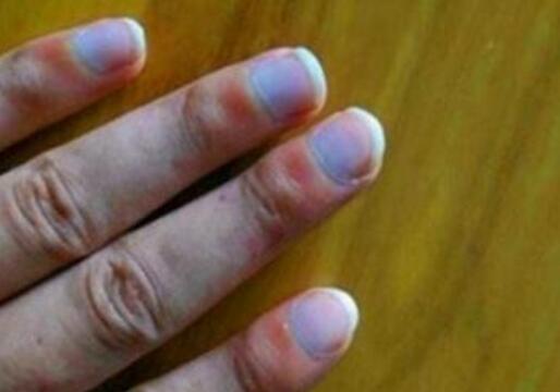 ʲô��������ָ�ף�������ָ������֢��